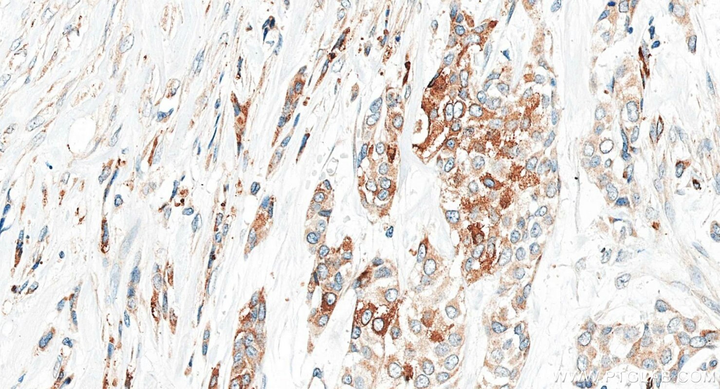 IHC staining of human urothelial carcinoma using 34200-1-AP (same clone as 34200-1-PBS) Immunohistochemistry (IHC) staining of human urothelial carcinoma tissue using DOLPP1 Polyclonal antibody (34200-1-AP)
