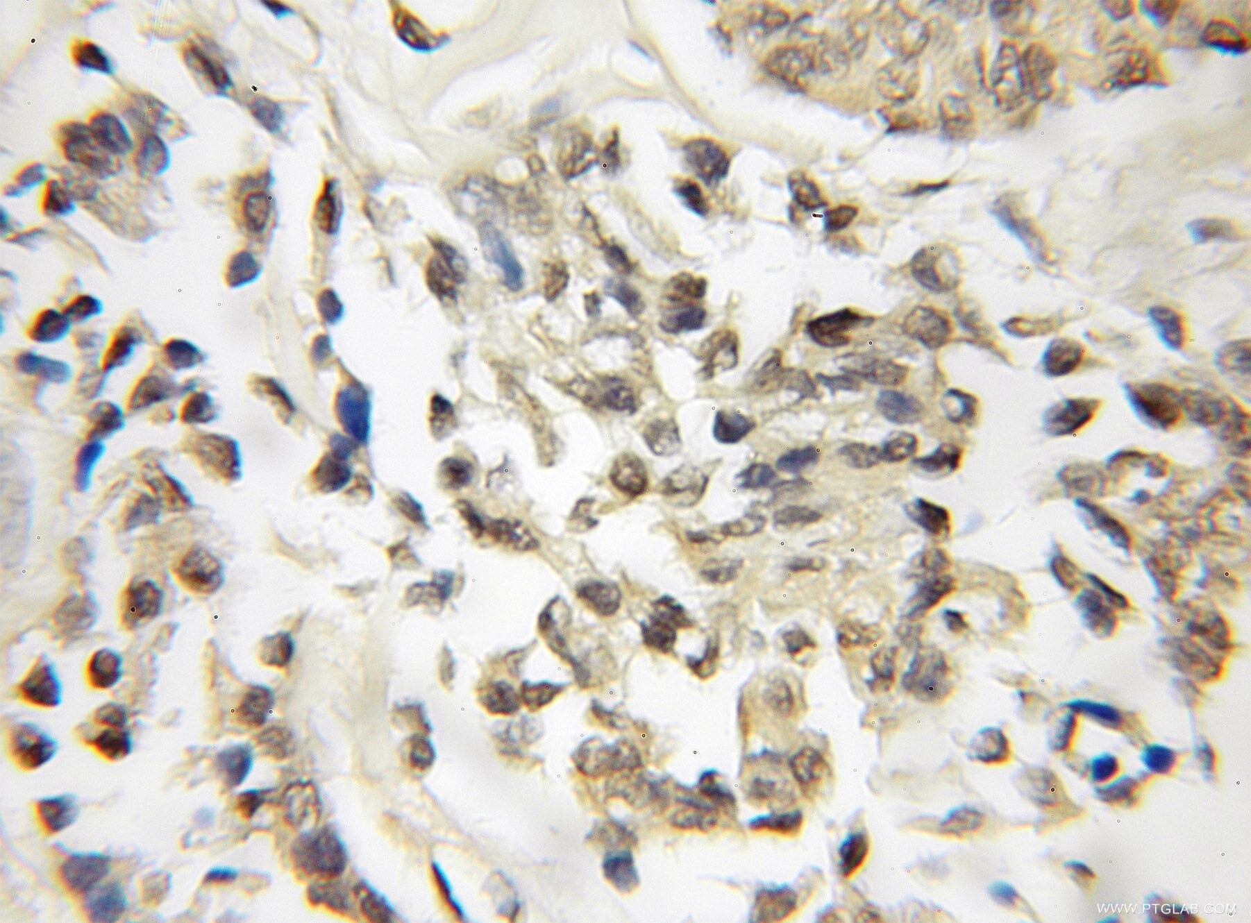 Immunohistochemistry (IHC) staining of human breast cancer tissue using DOM3Z Polyclonal antibody (11015-2-AP)
