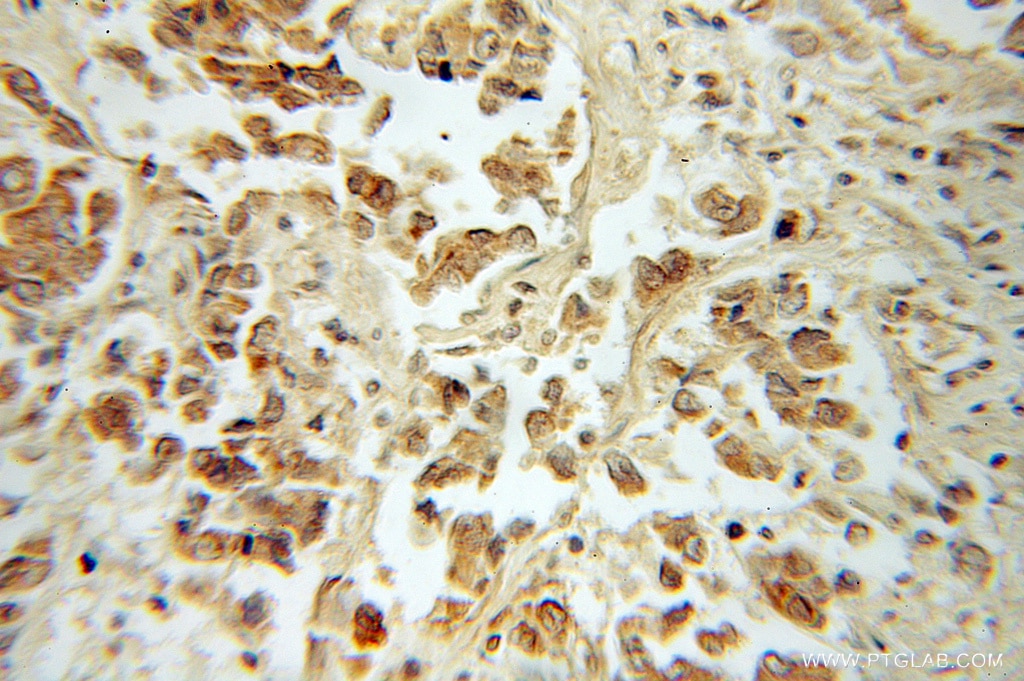 Immunohistochemistry (IHC) staining of human breast cancer tissue using DOM3Z Polyclonal antibody (11015-2-AP)