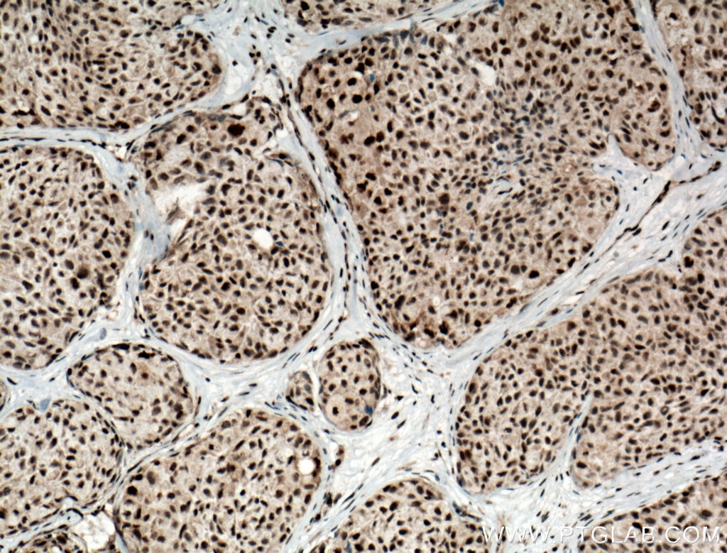 Immunohistochemistry (IHC) staining of human lung cancer tissue using DPF2 Polyclonal antibody (12111-1-AP)