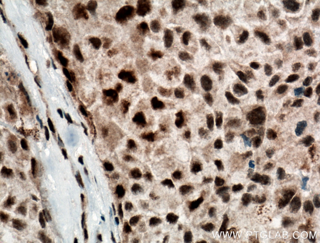 Immunohistochemistry (IHC) staining of human lung cancer tissue using DPF2 Polyclonal antibody (12111-1-AP)