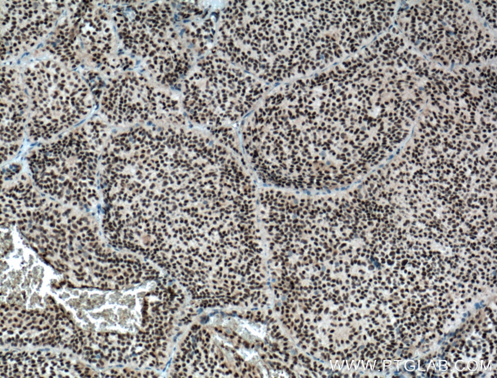 Immunohistochemistry (IHC) staining of human pituitary adenoma tissue using DPF2 Polyclonal antibody (12111-1-AP)