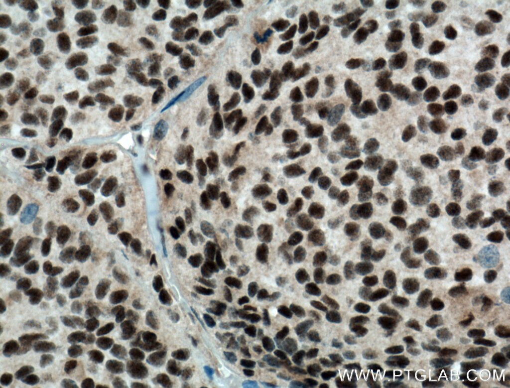 Immunohistochemistry (IHC) staining of human pituitary adenoma tissue using DPF2 Polyclonal antibody (12111-1-AP)