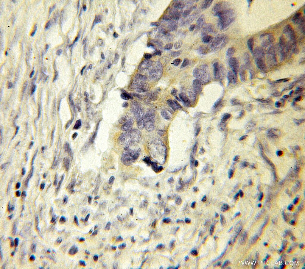 Immunohistochemistry (IHC) staining of human colon cancer tissue using DPH2 Polyclonal antibody (12367-1-AP)
