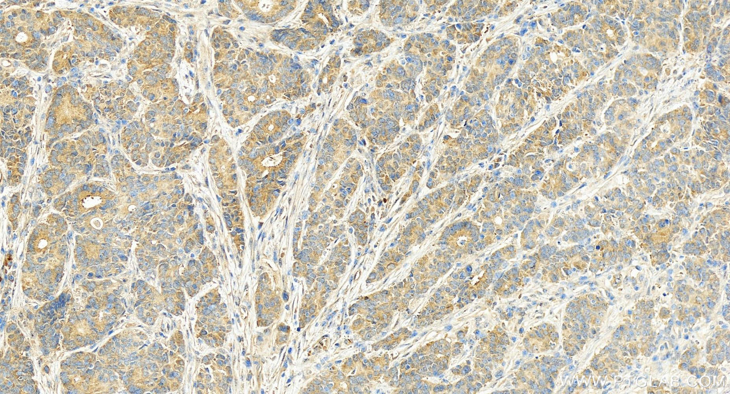 Immunohistochemical analysis of paraffin-embedded human stomach cancer tissue slide using 14866-1-AP (DPH2 antibody) at dilution of 1:200 (under 20x lens). Heat mediated antigen retrieval with Tris-EDTA buffer (pH 9.0). Immunohistochemistry (IHC) staining of human stomach cancer tissue using DPH2 Polyclonal antibody (14866-1-AP)