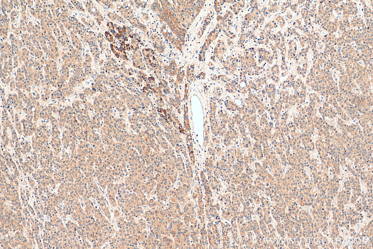 IHC staining of human liver cancer using 12403-2-AP