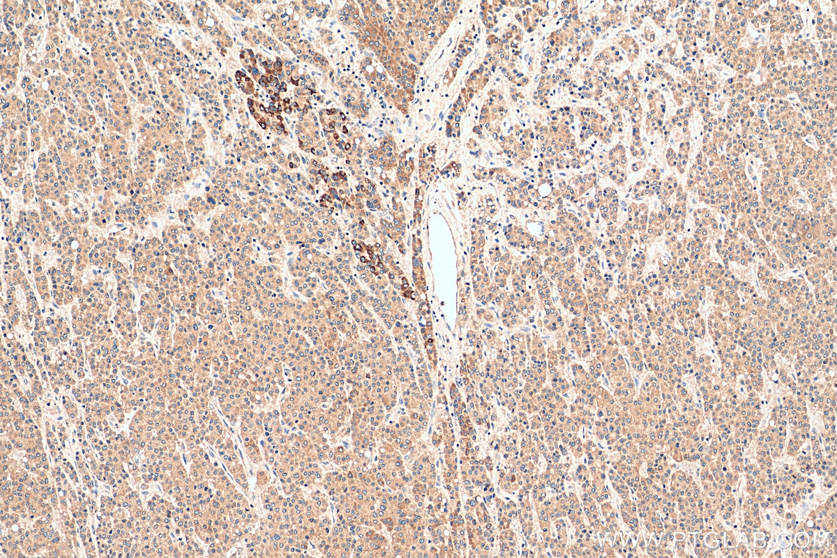 Immunohistochemistry (IHC) staining of human liver cancer tissue using DPM1 Polyclonal antibody (12403-2-AP)