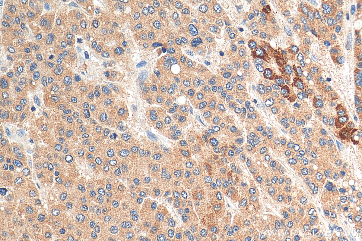 Immunohistochemistry (IHC) staining of human liver cancer tissue using DPM1 Polyclonal antibody (12403-2-AP)