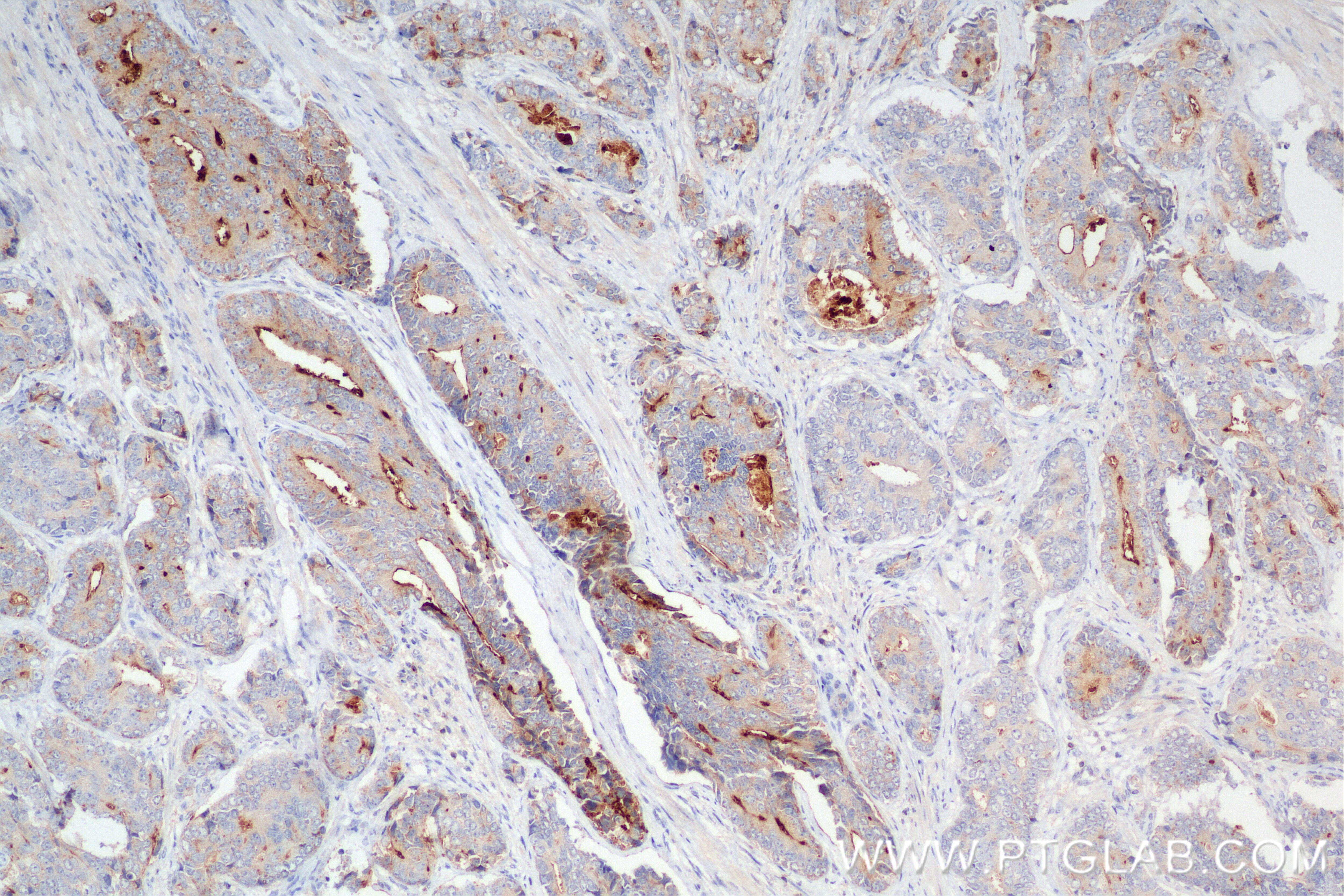 Immunohistochemistry (IHC) staining of human prostate cancer tissue using DPP4/CD26 Recombinant antibody (84606-6-RR)