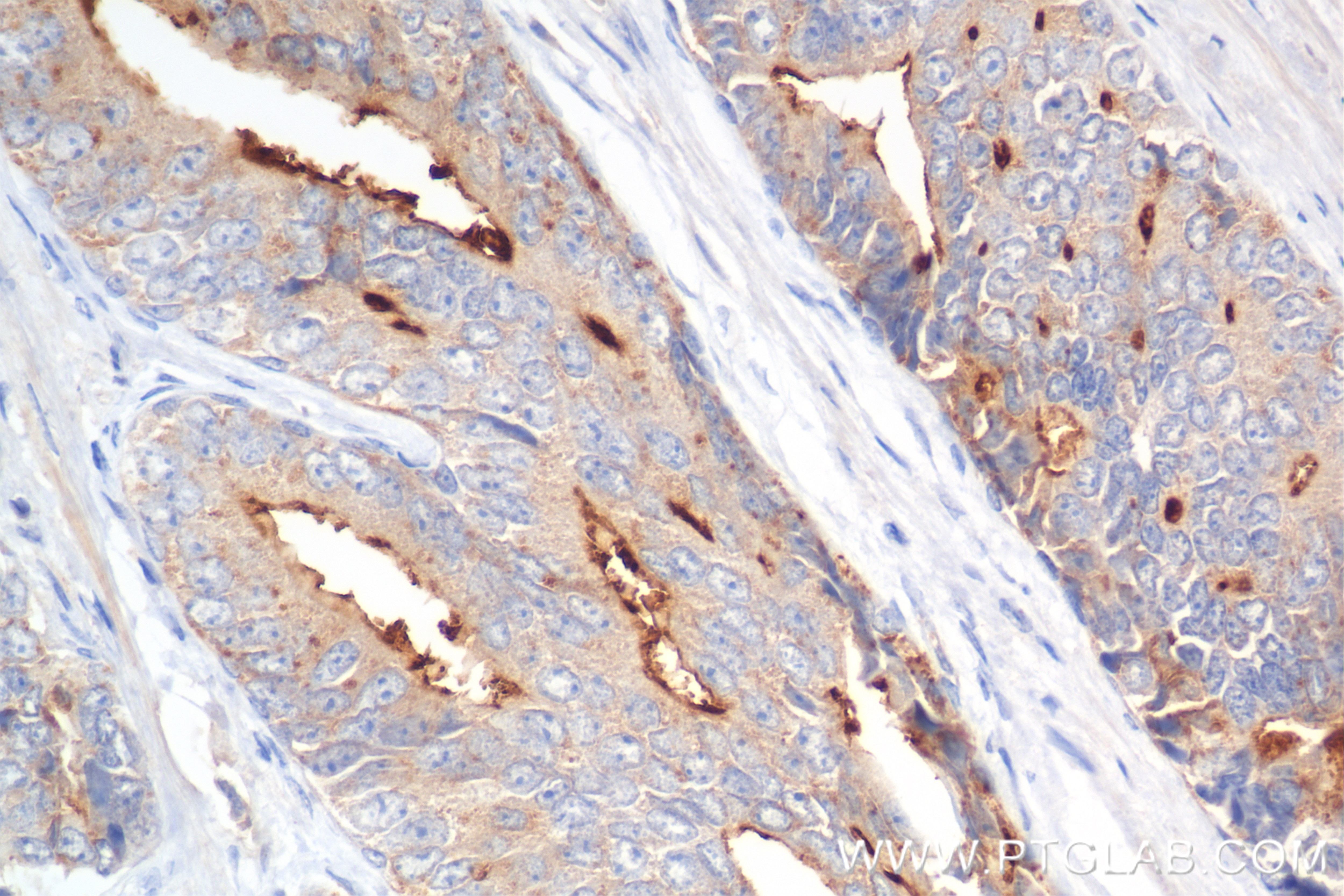 Immunohistochemistry (IHC) staining of human prostate cancer tissue using DPP4/CD26 Recombinant antibody (84606-6-RR)