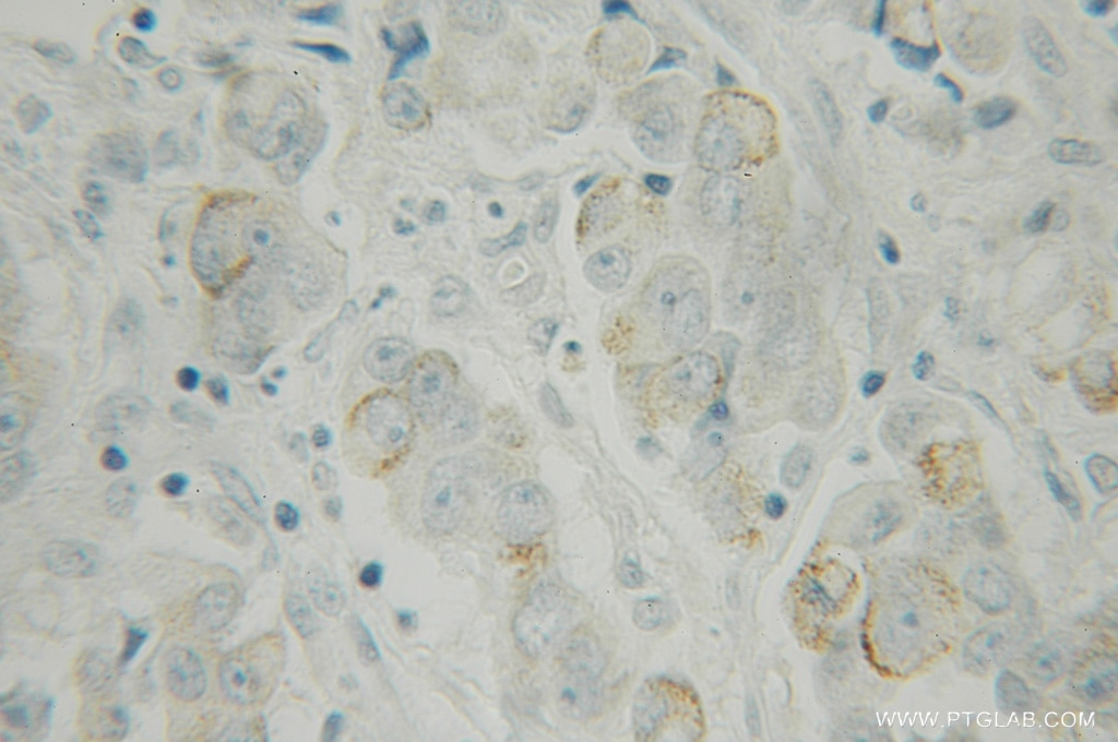 Immunohistochemistry (IHC) staining of human prostate cancer tissue using DPP8 Polyclonal antibody (12752-1-AP)