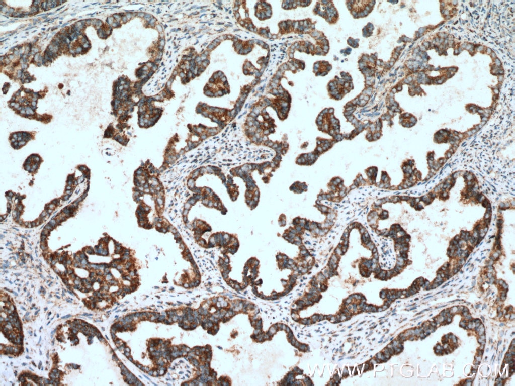 Immunohistochemistry (IHC) staining of human ovary tumor tissue using DPP9 Polyclonal antibody (11568-1-AP)