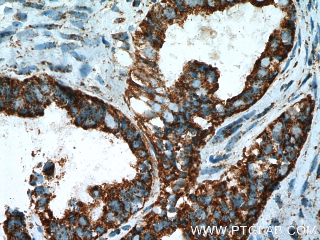 Immunohistochemistry (IHC) staining of human ovary tumor tissue using DPP9 Polyclonal antibody (11568-1-AP)
