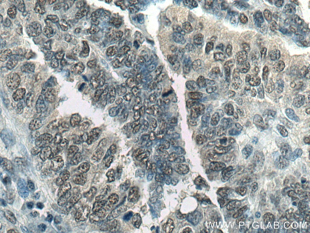 Immunohistochemistry (IHC) staining of human ovary tumor tissue using DPY30 Polyclonal antibody (16281-1-AP)
