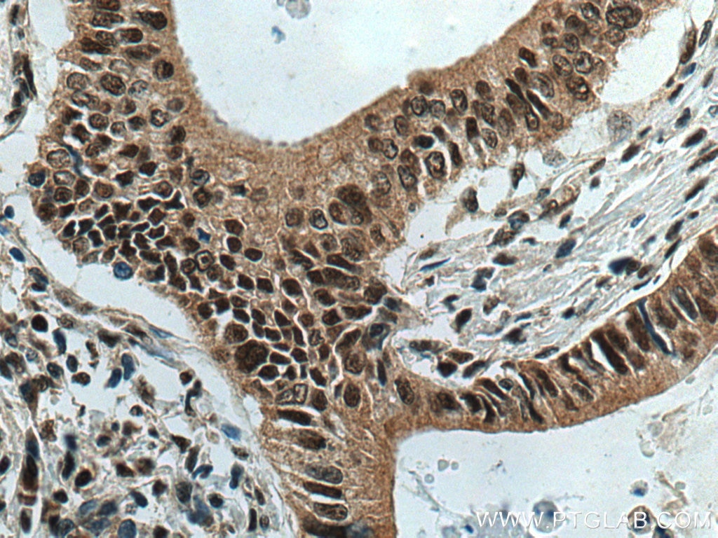 Immunohistochemistry (IHC) staining of human stomach cancer tissue using DPY30 Polyclonal antibody (16281-1-AP)