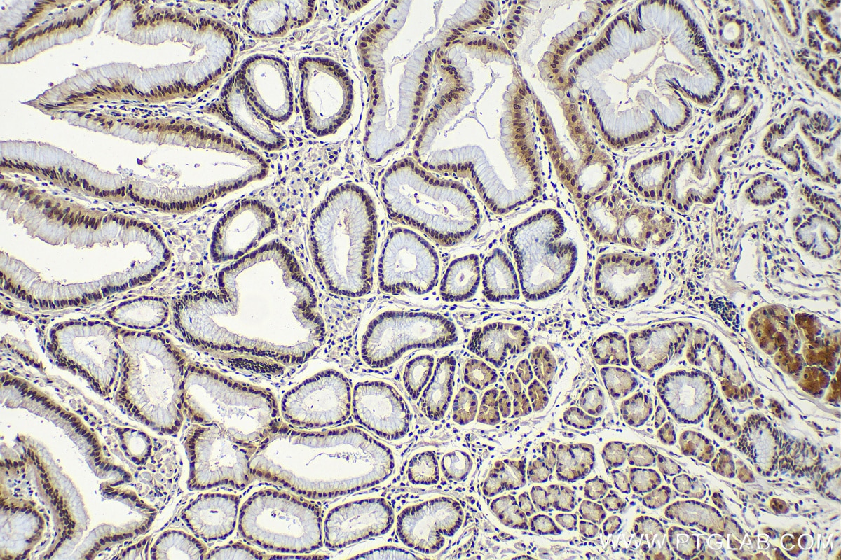 IHC staining of human stomach cancer using 16281-1-AP