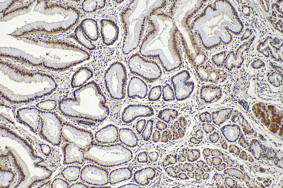 Immunohistochemistry (IHC) staining of human stomach cancer tissue using DPY30 Polyclonal antibody (16281-1-AP)