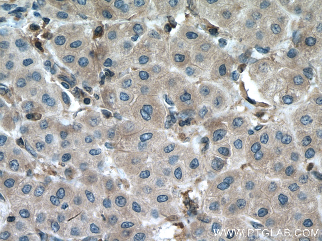 Immunohistochemistry (IHC) staining of human liver cancer tissue using DPYD Polyclonal antibody (27662-1-AP)