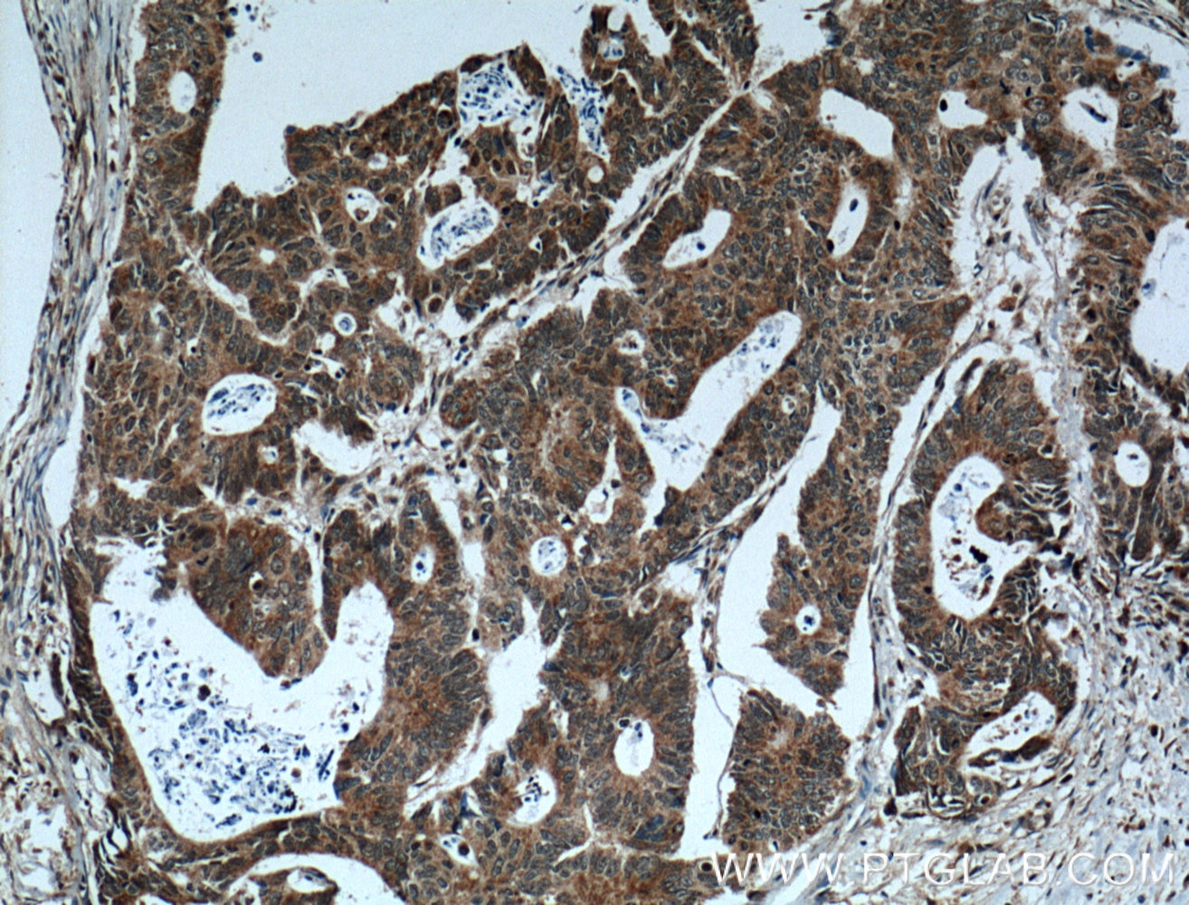Immunohistochemistry (IHC) staining of human colon cancer tissue using CRMP2 Polyclonal antibody (14521-1-AP)