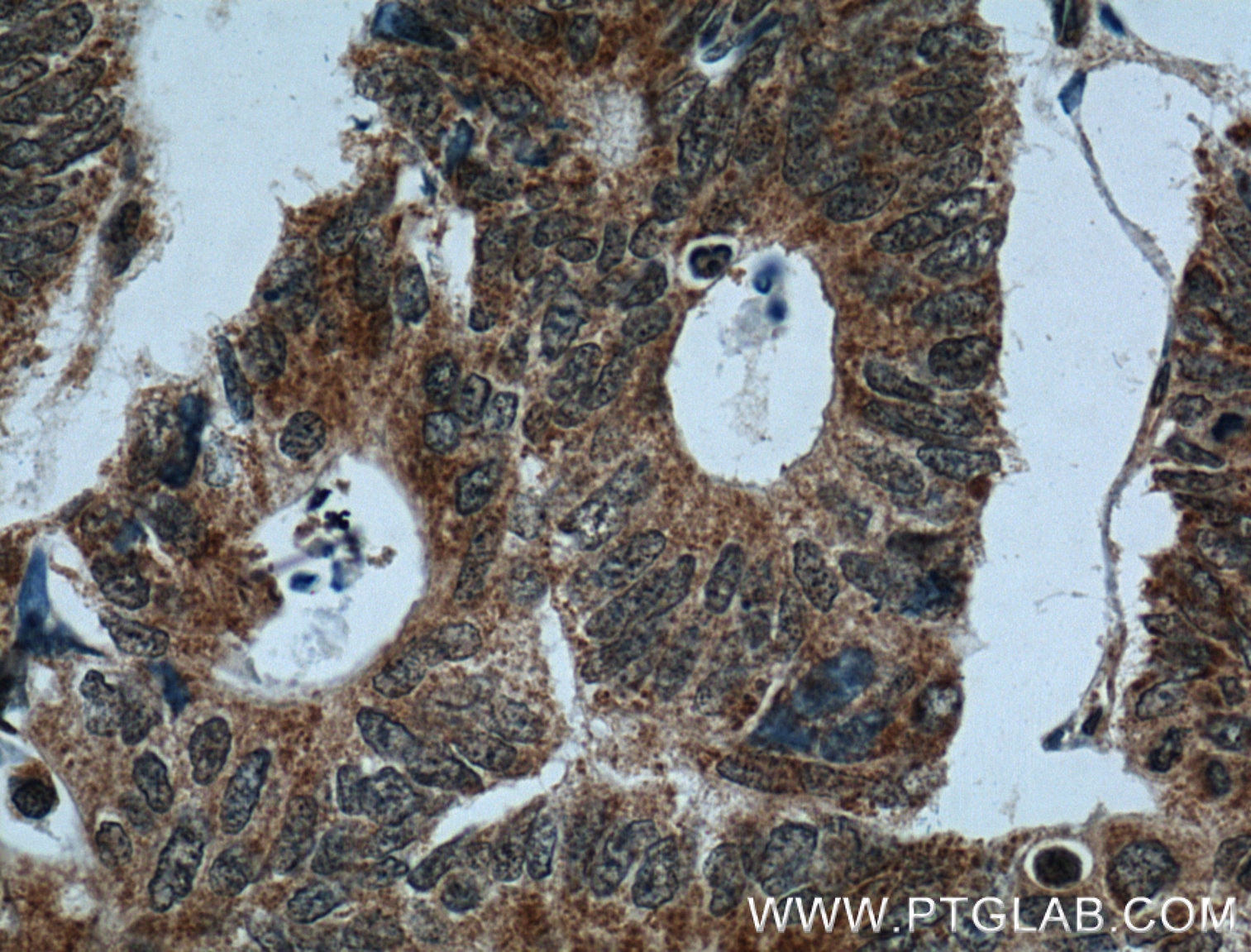 Immunohistochemistry (IHC) staining of human colon cancer tissue using CRMP2 Polyclonal antibody (14521-1-AP)