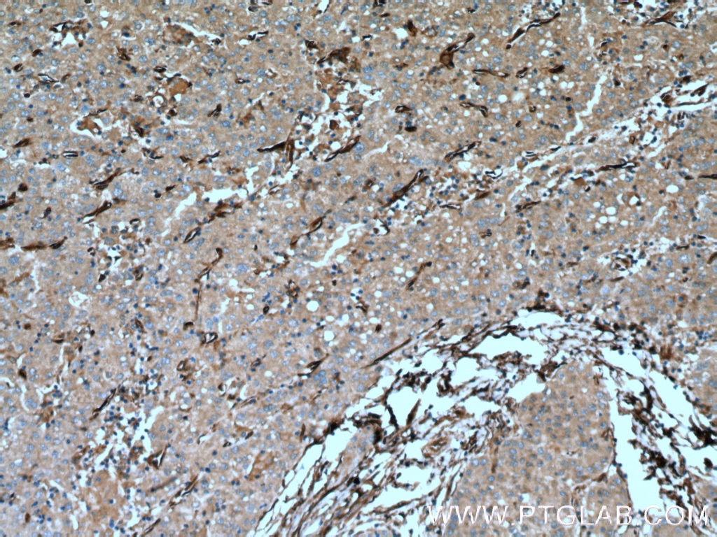 Immunohistochemistry (IHC) staining of human liver cancer tissue using CRMP4 Polyclonal antibody (18969-1-AP)