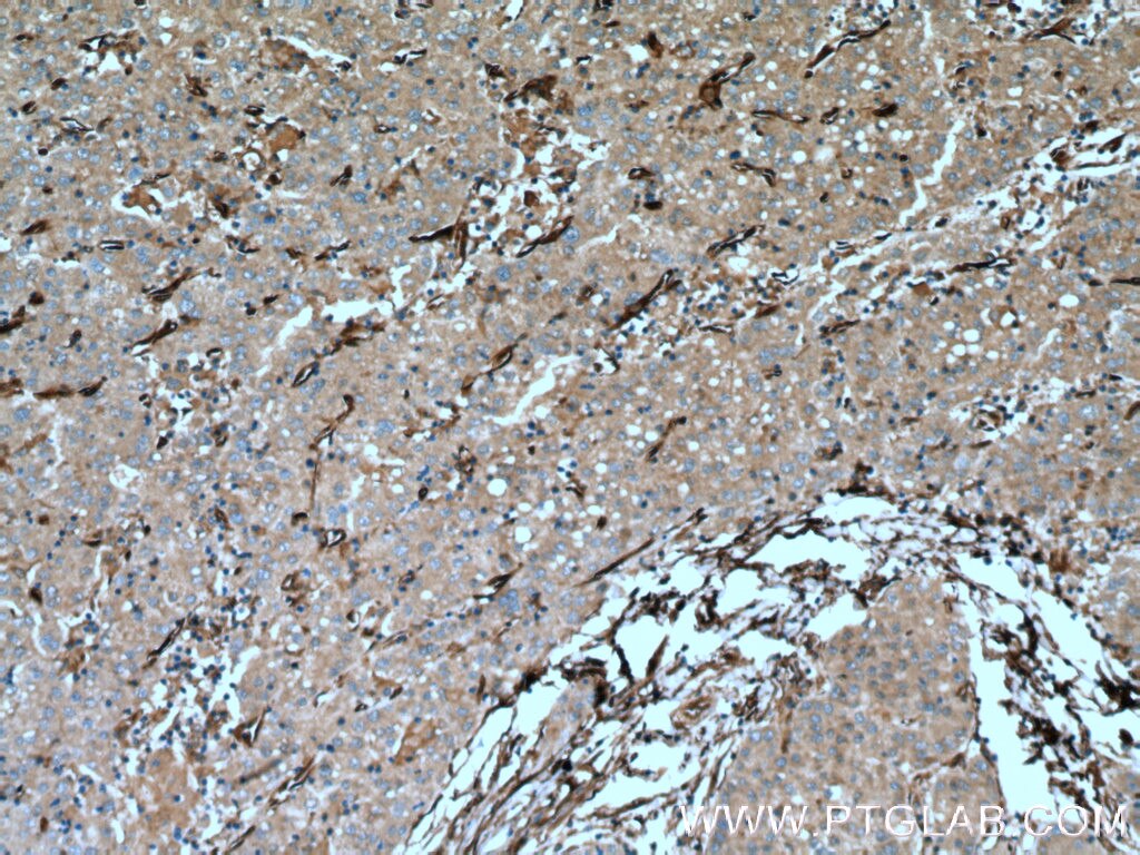 Immunohistochemistry (IHC) staining of human liver cancer tissue using CRMP4 Polyclonal antibody (18969-1-AP)