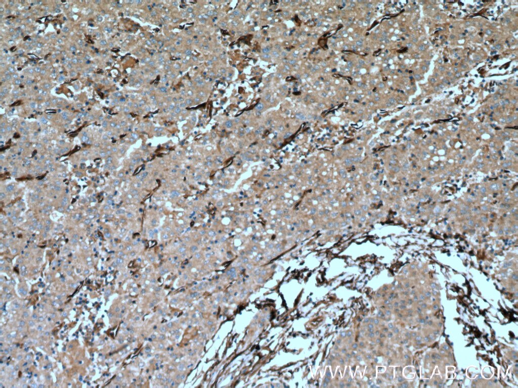 Immunohistochemistry (IHC) staining of human liver cancer tissue using CRMP4 Polyclonal antibody (18969-1-AP)