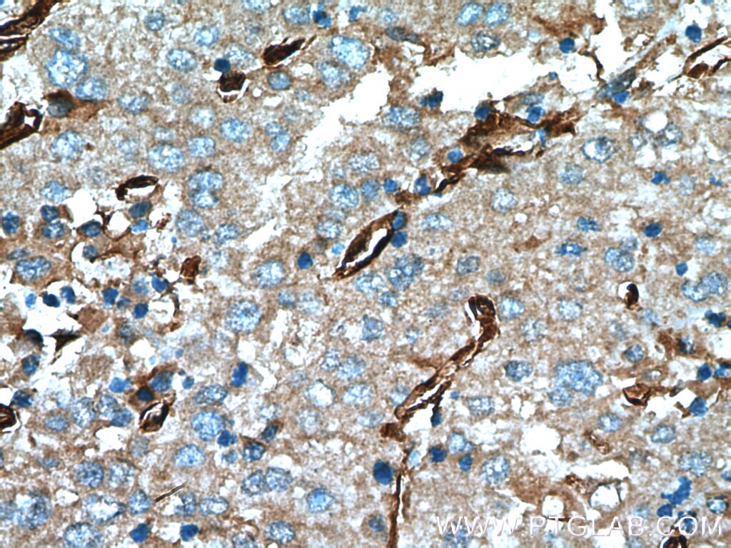 Immunohistochemistry (IHC) staining of human liver cancer tissue using CRMP4 Polyclonal antibody (18969-1-AP)