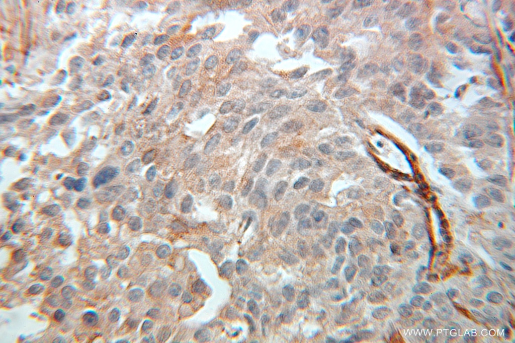 Immunohistochemistry (IHC) staining of human prostate cancer tissue using CRMP5 Polyclonal antibody (10525-1-AP)