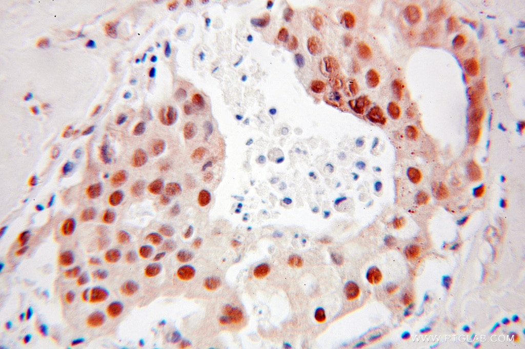 Immunohistochemistry (IHC) staining of human breast cancer tissue using DR1 Polyclonal antibody (10406-1-AP)