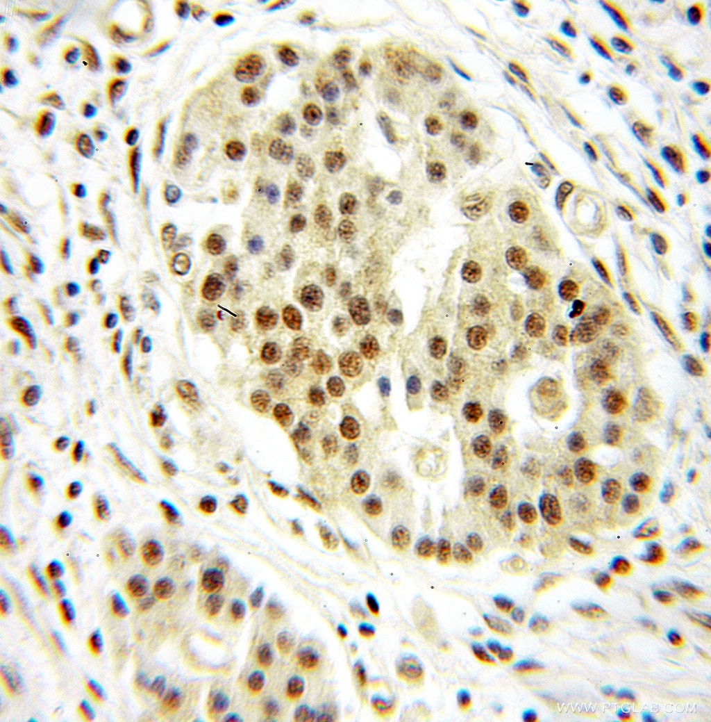 Immunohistochemistry (IHC) staining of human pancreas cancer tissue using DRAP1 Polyclonal antibody (11020-1-AP)