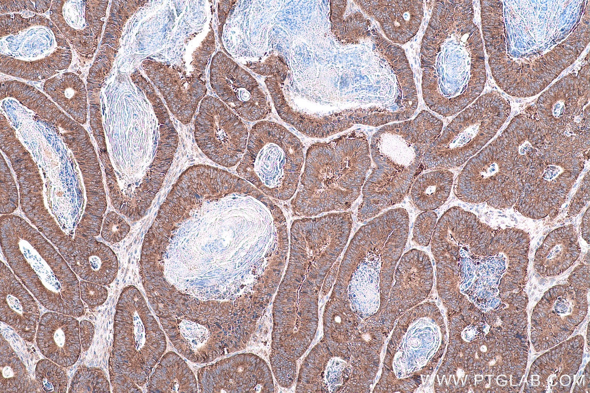 Immunohistochemistry (IHC) staining of human colon cancer tissue using DRG1 Polyclonal antibody (13190-1-AP)