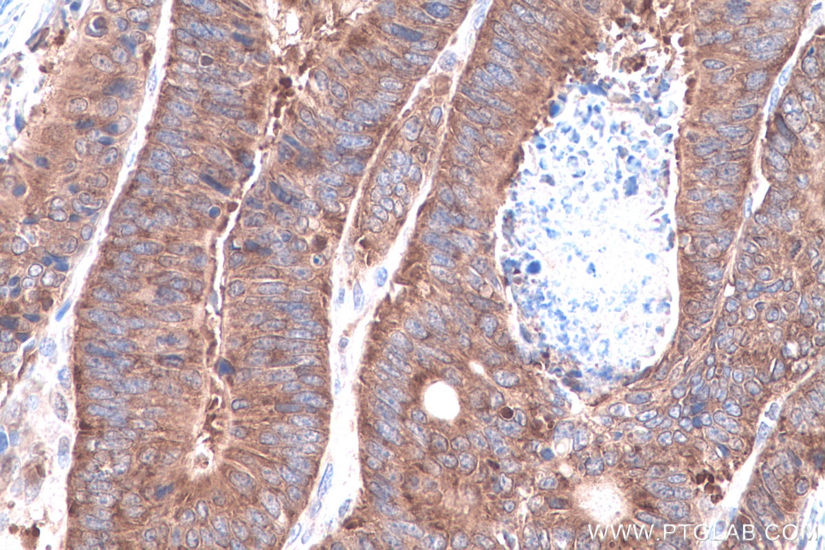 Immunohistochemistry (IHC) staining of human colon cancer tissue using DRG1 Polyclonal antibody (13190-1-AP)