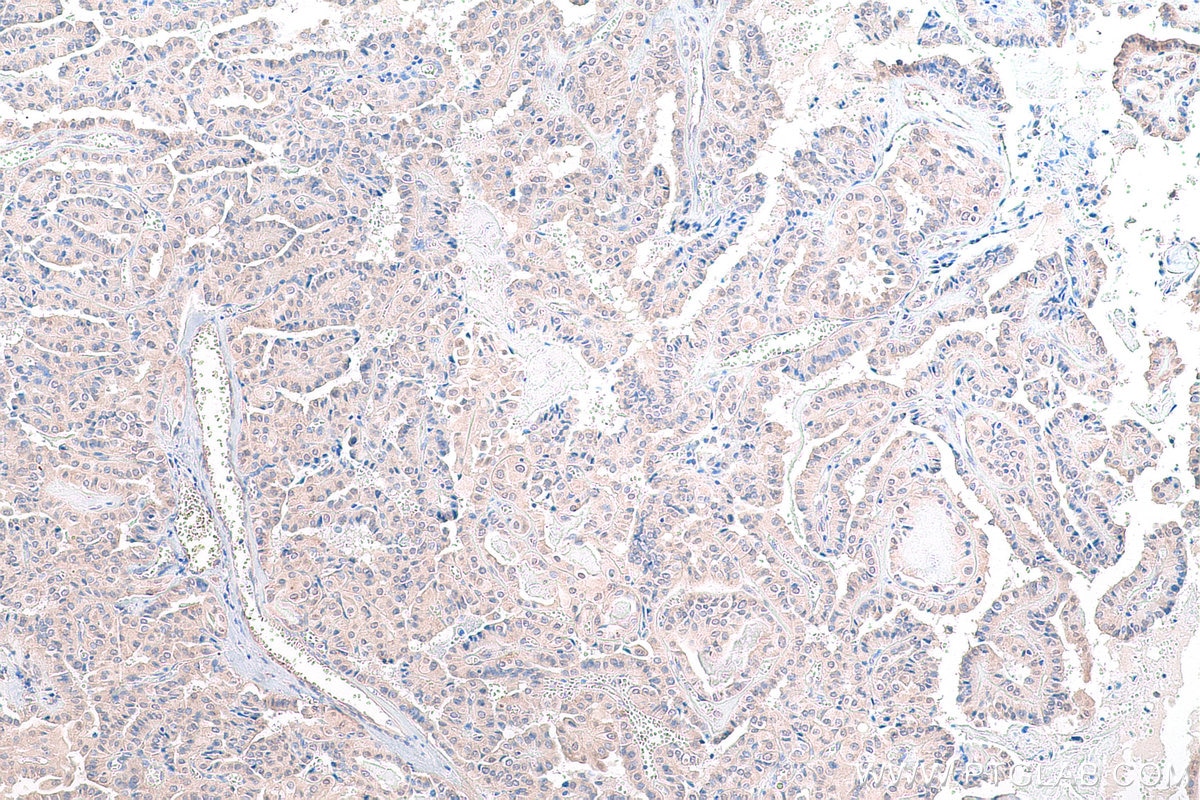 IHC staining of human thyroid cancer using 13190-1-AP