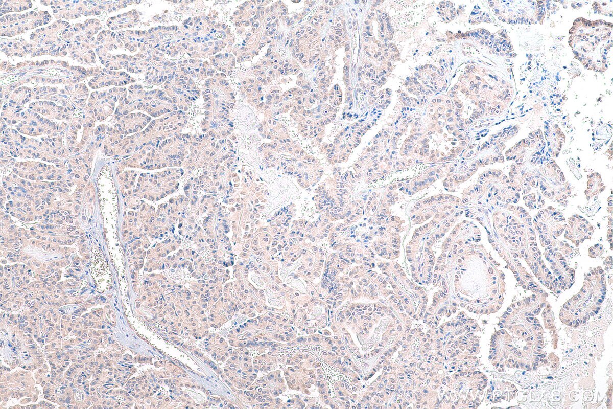 Immunohistochemistry (IHC) staining of human thyroid cancer tissue using DRG1 Polyclonal antibody (13190-1-AP)