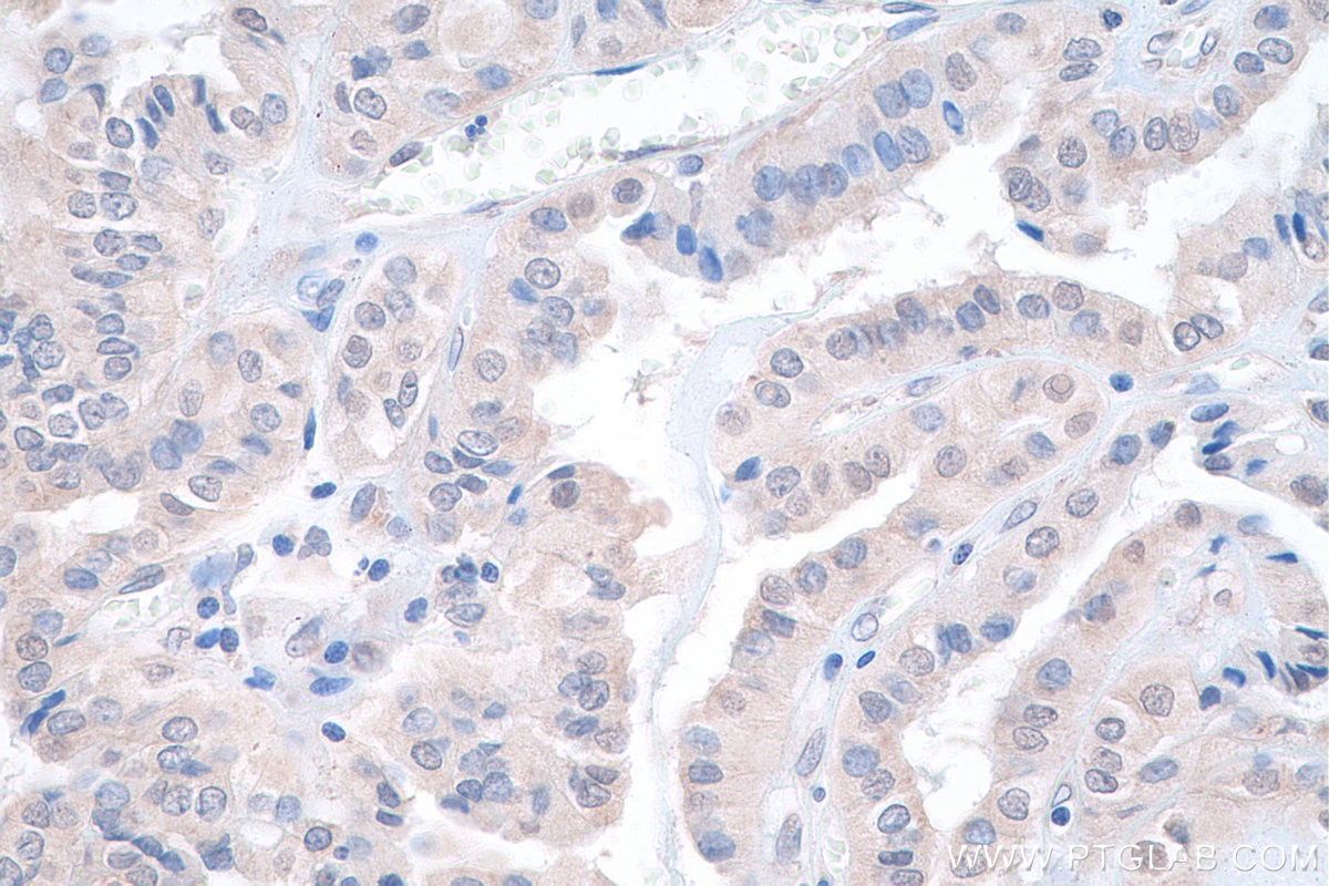 Immunohistochemistry (IHC) staining of human thyroid cancer tissue using DRG1 Polyclonal antibody (13190-1-AP)