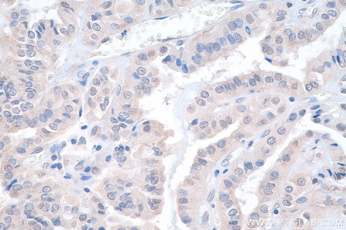 Immunohistochemistry (IHC) staining of human thyroid cancer tissue using DRG1 Polyclonal antibody (13190-1-AP)