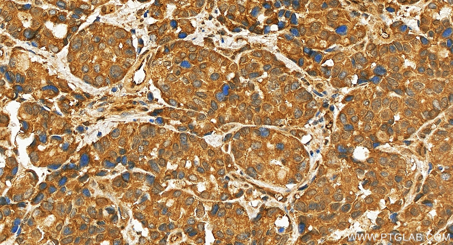 IHC staining of human stomach cancer using 27958-1-AP Immunohistochemistry (IHC) staining of human stomach cancer tissue using DROSHA Polyclonal antibody (27958-1-AP)