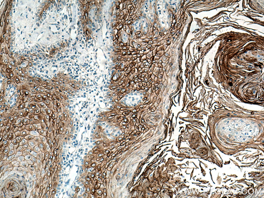 Immunohistochemistry (IHC) staining of human skin cancer tissue using Desmocollin 2 Polyclonal antibody (13876-1-AP)