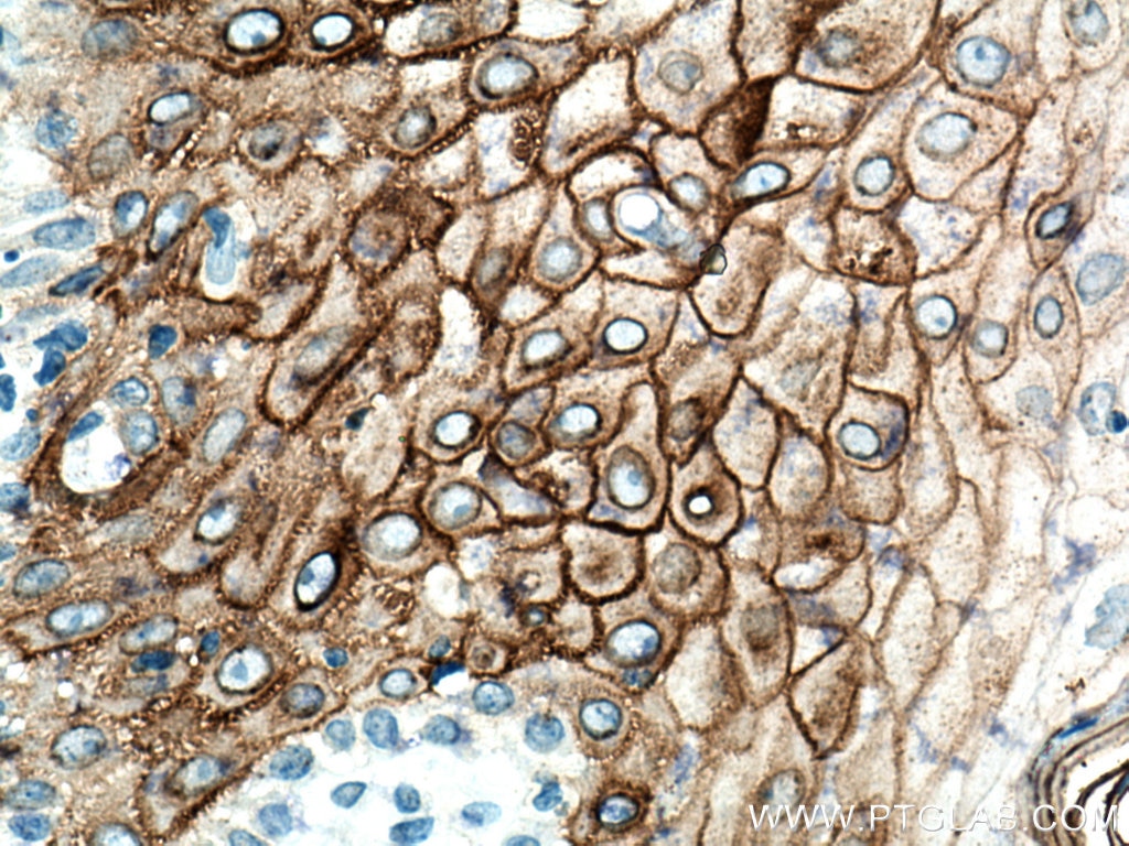 Immunohistochemistry (IHC) staining of human skin cancer tissue using Desmocollin 2 Polyclonal antibody (13876-1-AP)