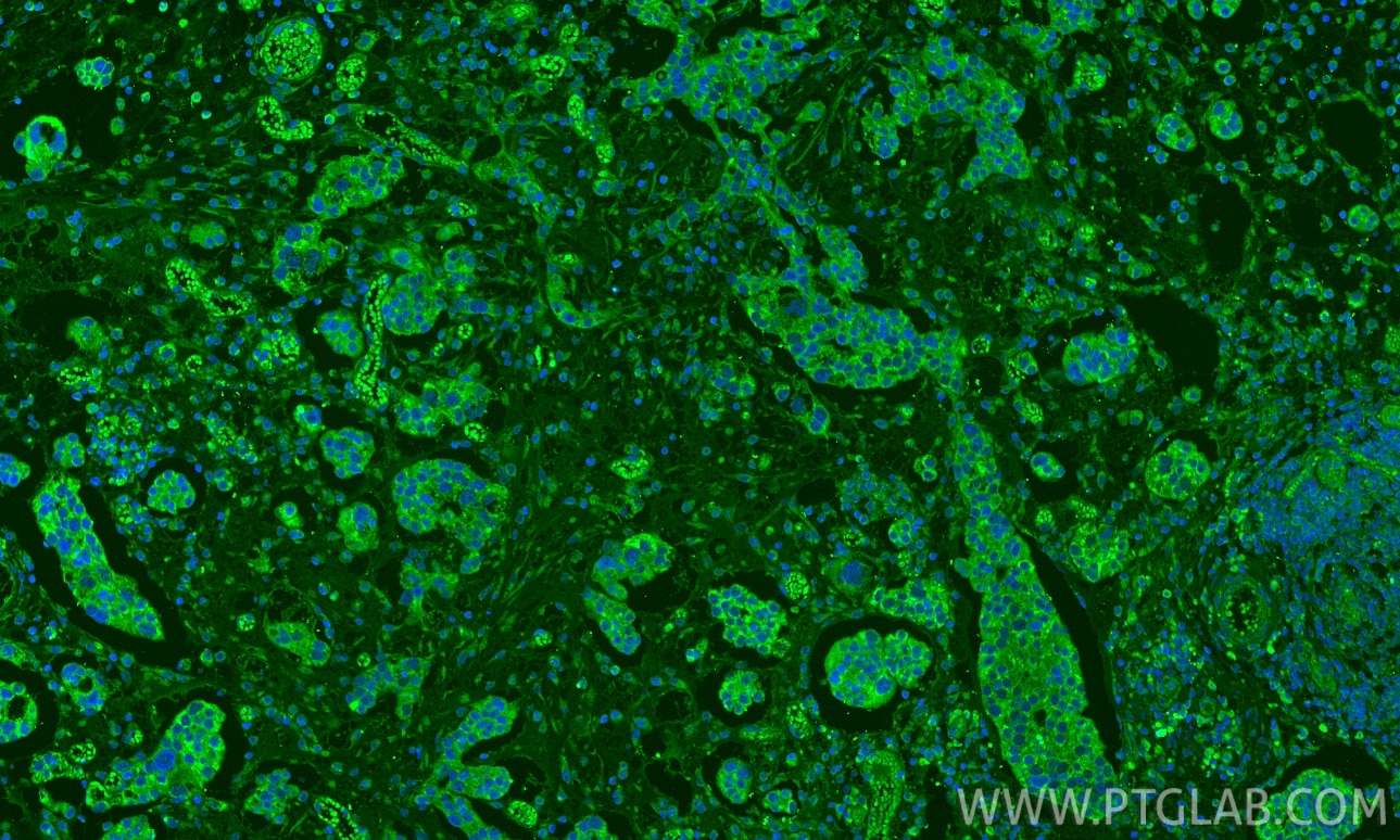 Immunofluorescence (IF) / fluorescent staining of human ovary cancer tissue using DSE Polyclonal antibody (10452-1-AP)