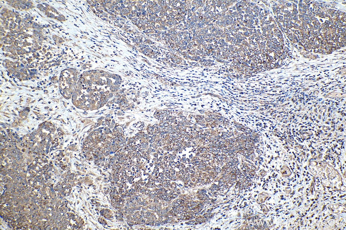 Immunohistochemistry (IHC) staining of human ovary tumor tissue using DSE Polyclonal antibody (10452-1-AP)