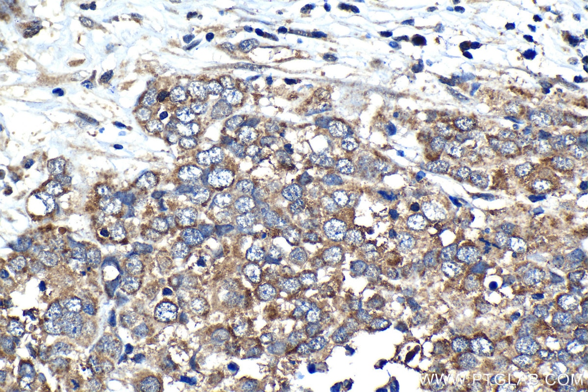 Immunohistochemistry (IHC) staining of human ovary tumor tissue using DSE Polyclonal antibody (10452-1-AP)