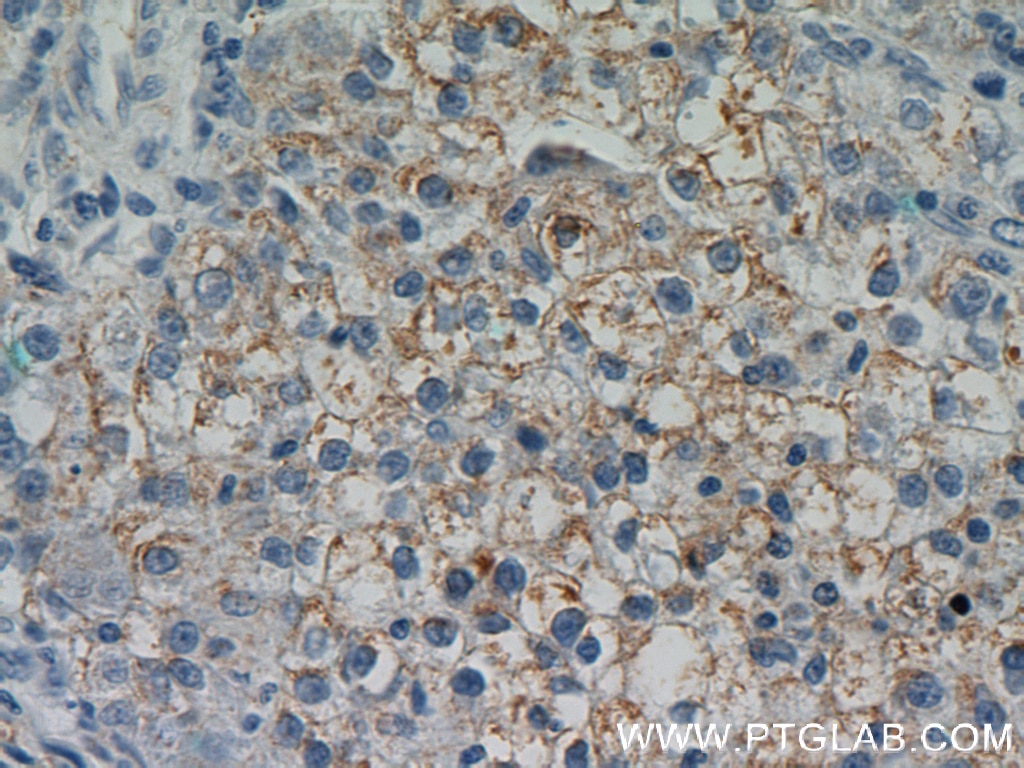 Immunohistochemistry (IHC) staining of human liver cancer tissue using DSE Polyclonal antibody (10452-1-AP)