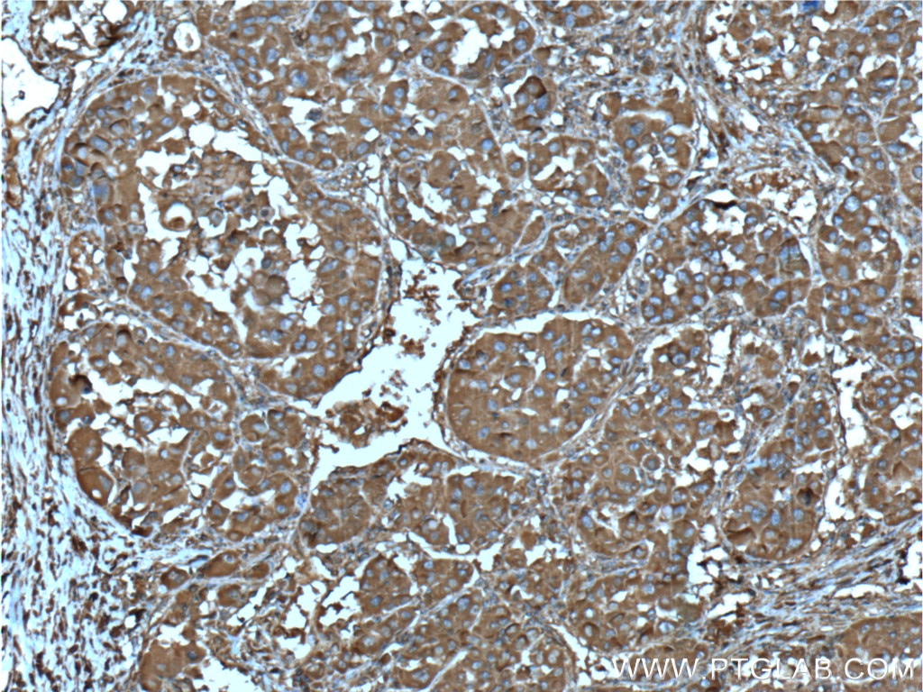 Immunohistochemistry (IHC) staining of human liver cancer tissue using DSE Monoclonal antibody (60041-1-Ig)