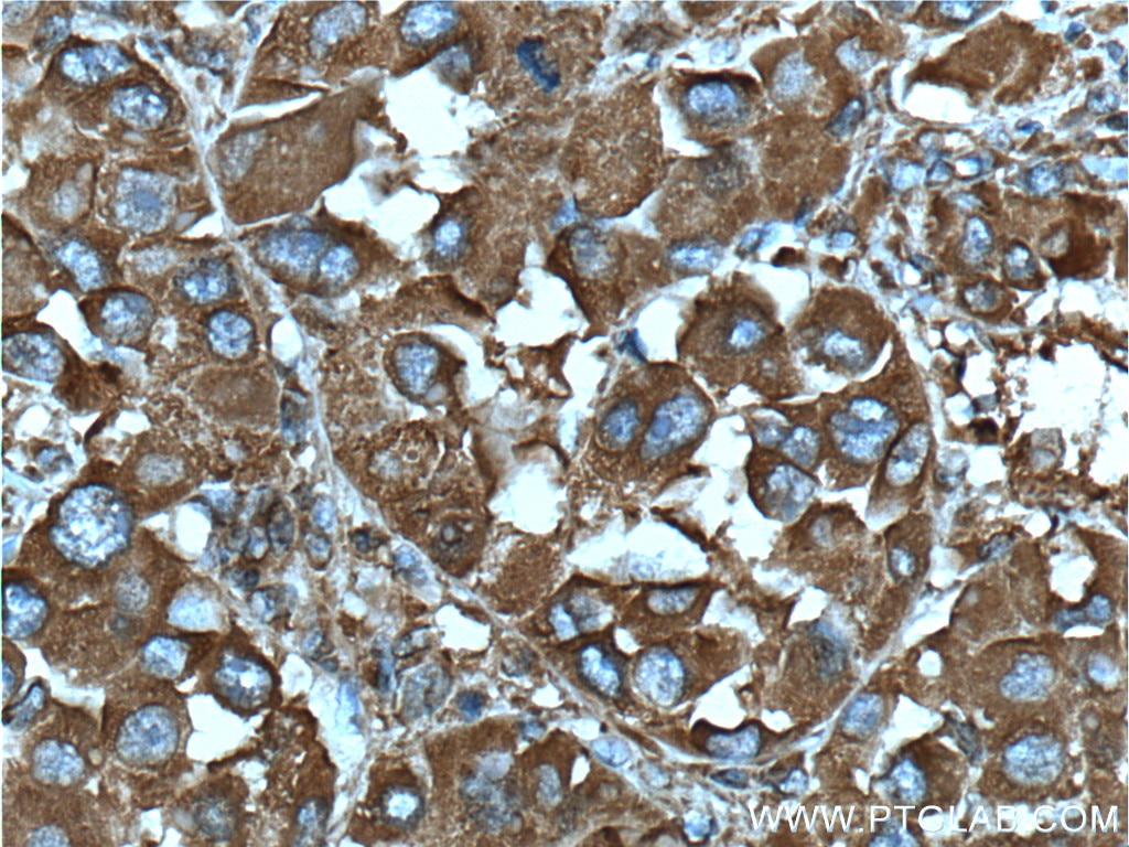 Immunohistochemistry (IHC) staining of human liver cancer tissue using DSE Monoclonal antibody (60041-1-Ig)