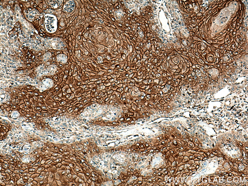 Immunohistochemistry (IHC) staining of human skin cancer tissue using DSG1 Polyclonal antibody (24587-1-AP)