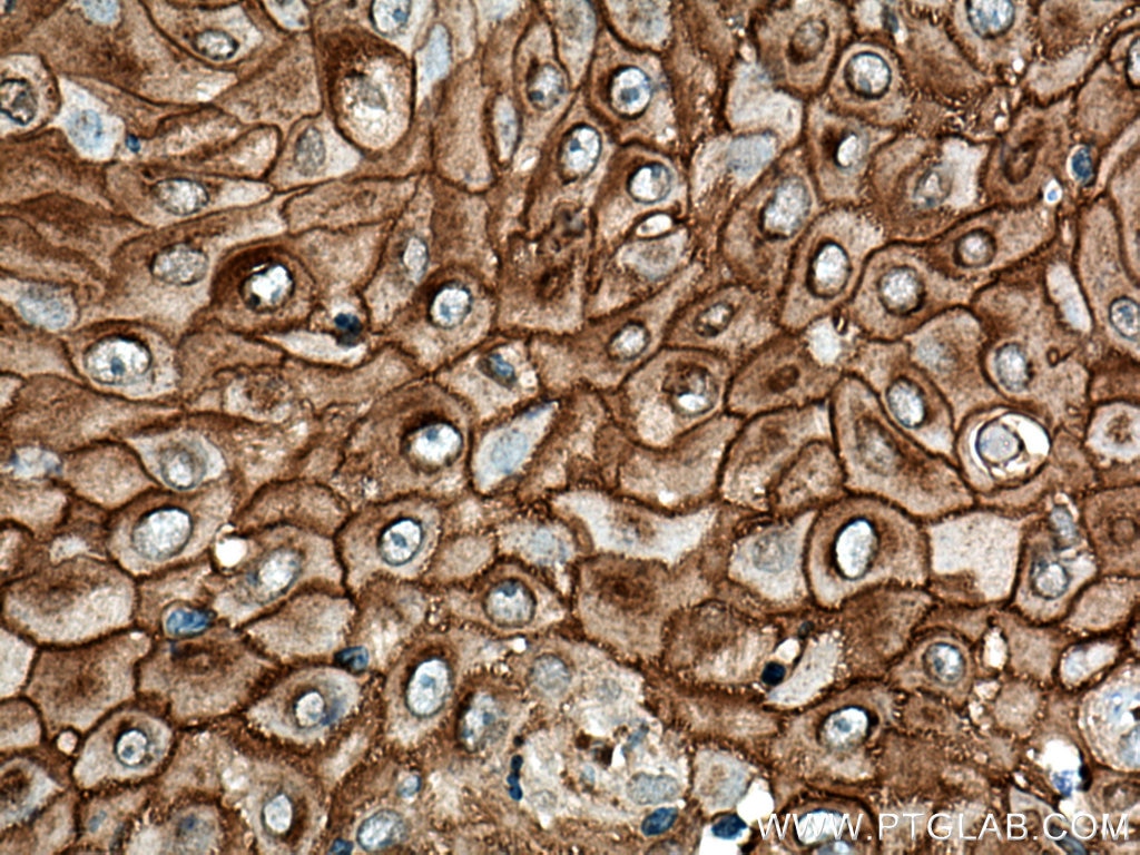 Immunohistochemistry (IHC) staining of human skin cancer tissue using DSG1 Polyclonal antibody (24587-1-AP)