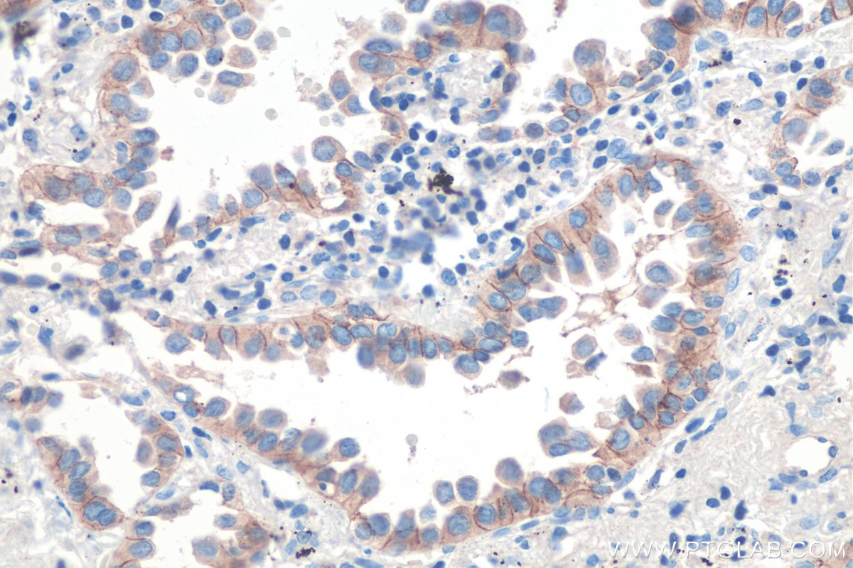 Immunohistochemistry (IHC) staining of human lung cancer tissue using DSG2 Polyclonal antibody (21880-1-AP)