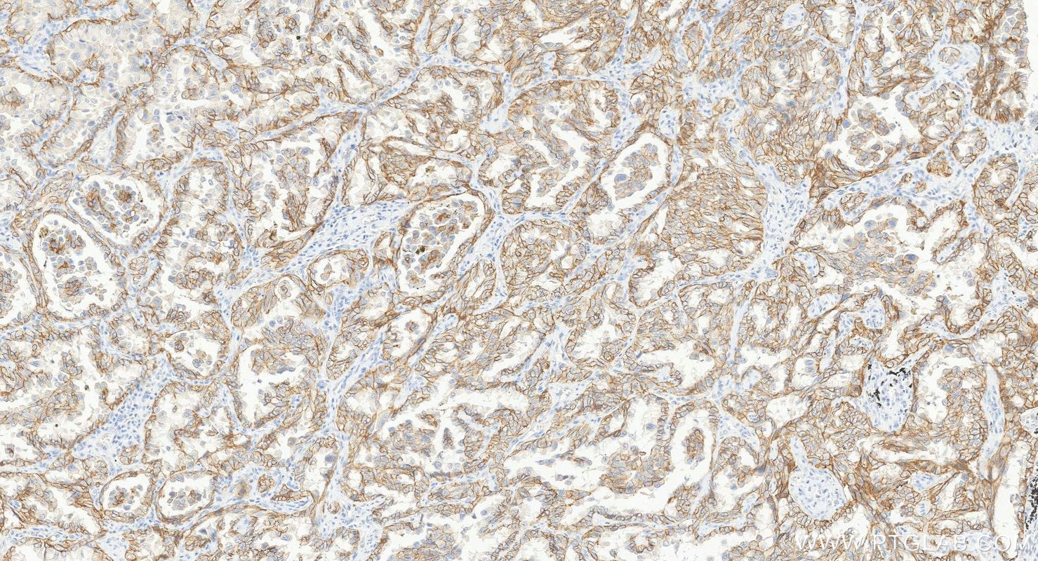 Immunohistochemistry (IHC) staining of human lung cancer tissue using DSG2 Polyclonal antibody (21880-1-AP)